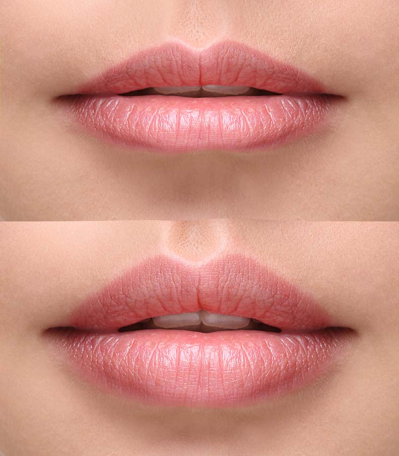 Before and After Lip Filler Treatment
